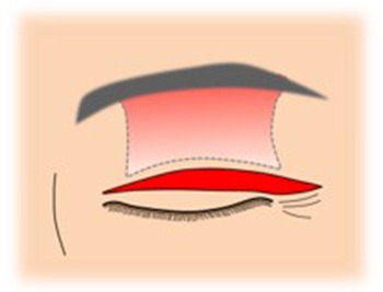 イメージ：眼瞼下垂手術2