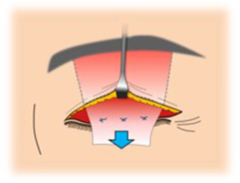 イメージ：眼瞼下垂手術3